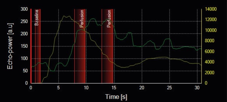Time windows selection on dual-scale graph, showing TIC from plaque and vascular lumen.