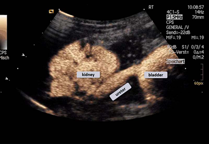 Vesicoureteral Reflux